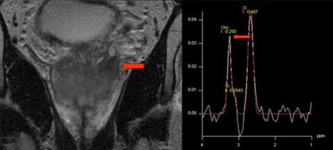 Coronal T2-weighted image and sample spectrum from spectroscopic imaging