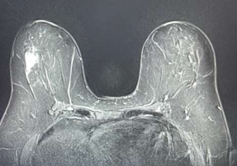 Case: Lymphoma of the Breast Figure 3