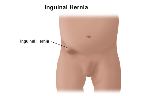 Inguinal Hernia diagram