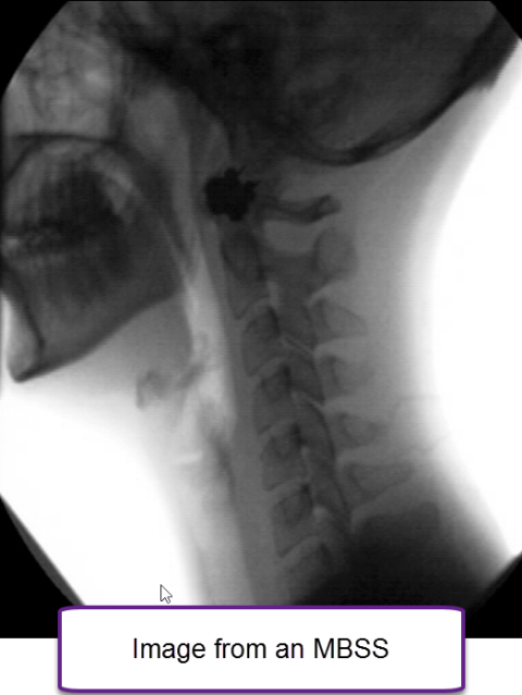 Modified barium swallow study (MBSS)