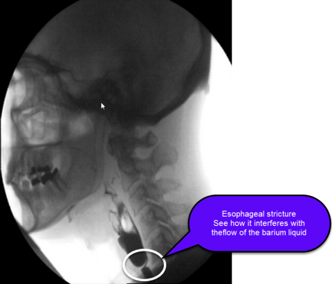Esophageal Stricture