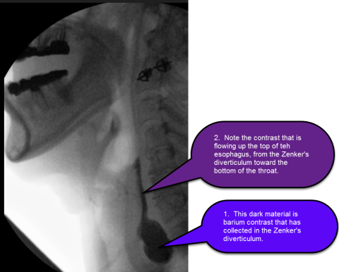 Zenker's Diverticulum