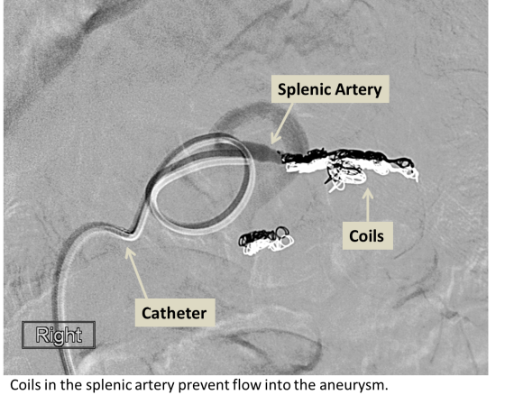 Aneurysm and Dissection - Interventional Radiology | UCLA Health