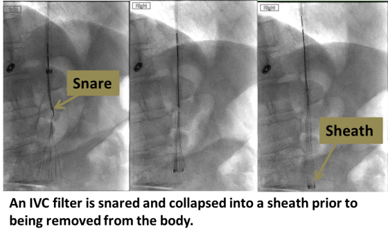 IVC Filter Removal IVC Filter UCLA Health IVC Filter Removal IVC Filter UCLA Health