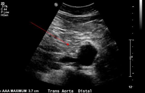 Abdominal Aortic Aneurysm - Interventional Radiology | UCLA Health