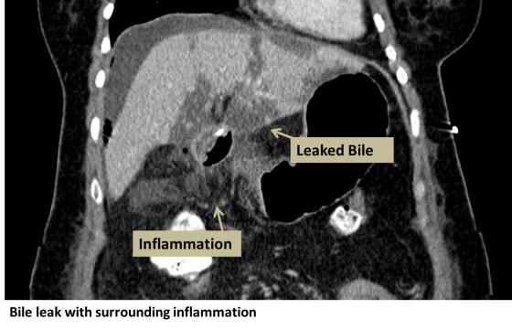 Biliary Leak - Interventional Radiology | UCLA Health