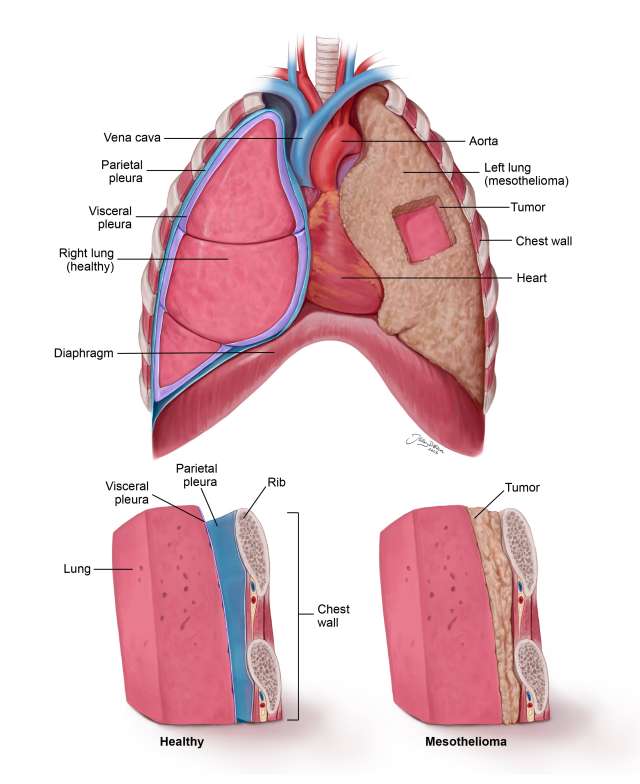 Pleural mesothelioma