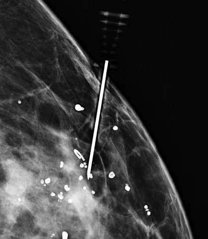 Procedure Mammographically Guided Wire Localizations Figure 3