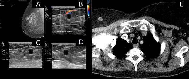 Case: Metastasis to the Breast From a Non-breast Primary Cancer Figure 4
