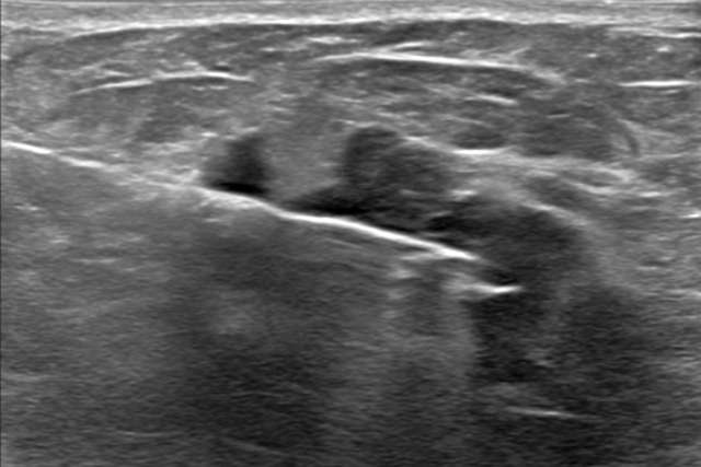 UCLA Radiology Breast Imaging Teaching Resources: Walkup