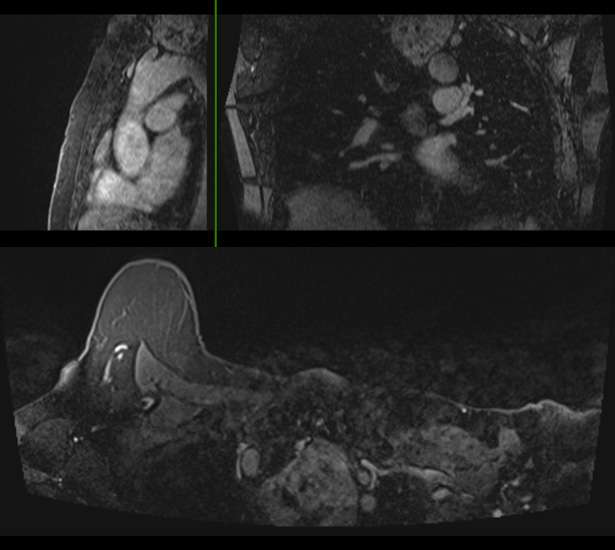 Case: Non Breast Finding Seen on Breast Imaging Figure 3