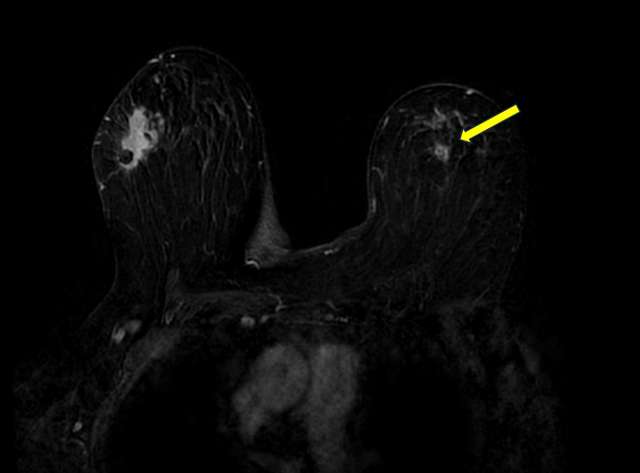 Case: Atypical Lobular Hyperplasia Figure 2