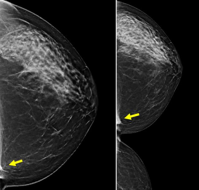 Case: Sternalis Muscle Figure 3