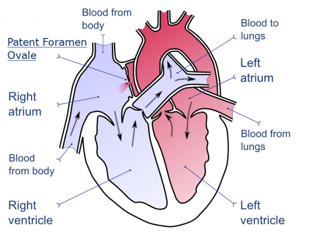 Patent foramen ovale diagram