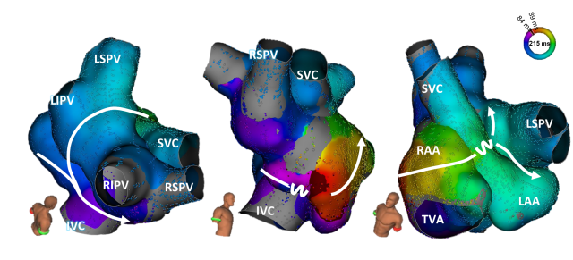 Three views of left atrial electroanatomical maps showing color-coded activation times and sequence (arrows) around pulmonary veins and major vessels.