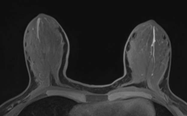 Case: Breast Ductal Anatomy and Function Figure 3