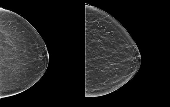 Figure 1. Examples of 2D mammography (left) and synthetic 2D mammography (right).