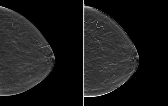 Figure 2. Two digital breast tomosynthesis “slices” from the same patient as in Figure 1. In the left image, the vascular calcifications are partially blurred because they are out of plane. In the right image, the vascular calcifications along part of the tortuous vessel are in plane and clearly seen, while the remainder of the vessel is out of plane.