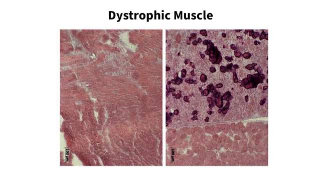 Dystrophic Muscle histology; left muscle fiber degeneration, right dense dark cellular infiltrates