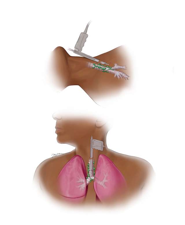 Diagram showing medical procedure for lung access with syringe and catheter.