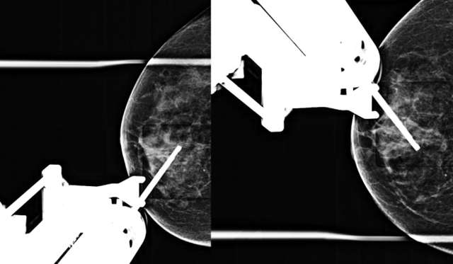 How to perform: Sterotactic (Mammographic guided biopsy) Figure 4