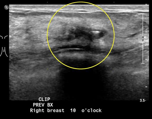 Case: Flat Epithelial Atypia Figure 2