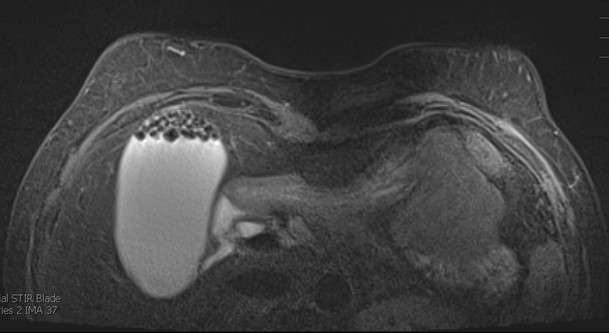 Case: Non Breast Finding Seen on Breast Imaging Figure 1