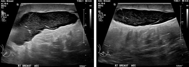 Case: Post-Surgical Fluid Collections Figure 4