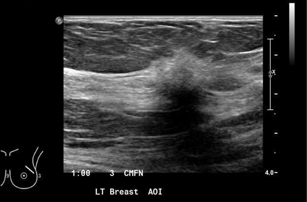 Mammography: Masses Figure 5