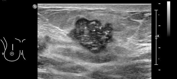 Mammography: Masses Figure 4