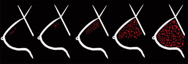 Distribution of Calcifications
