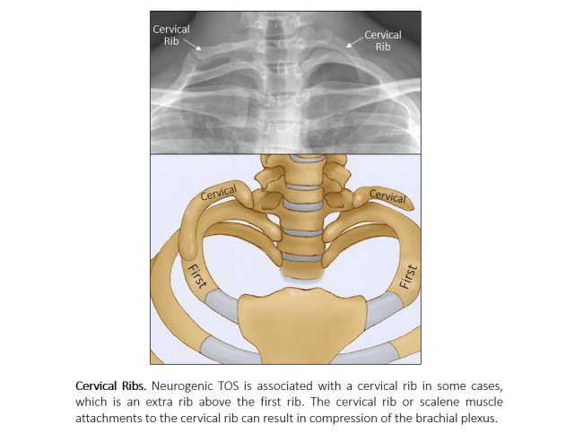 Cervical Rib Diagram