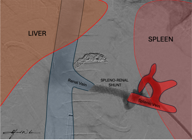 Illustration of a how a spleno_renal shunt works.