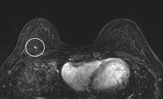 Case: Atypical Ductal Hyperplasia Figure 3