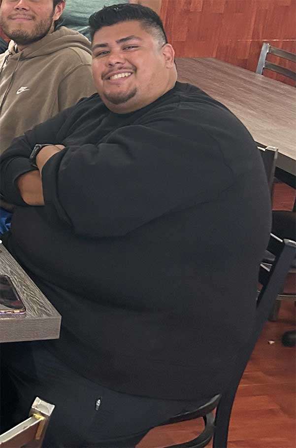 Before Gastric Sleeve Surgery