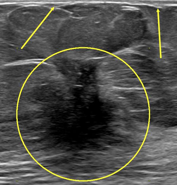 Case: Skin and Nipple Changes Figure 2