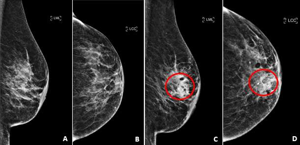 Case: Seromas and Hematomas Figure 4