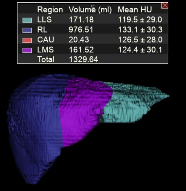 Liver Segmentation