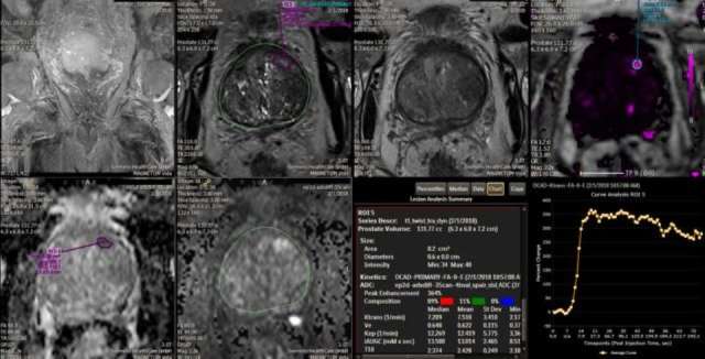 Prostate Cancer Pharmacokinetics