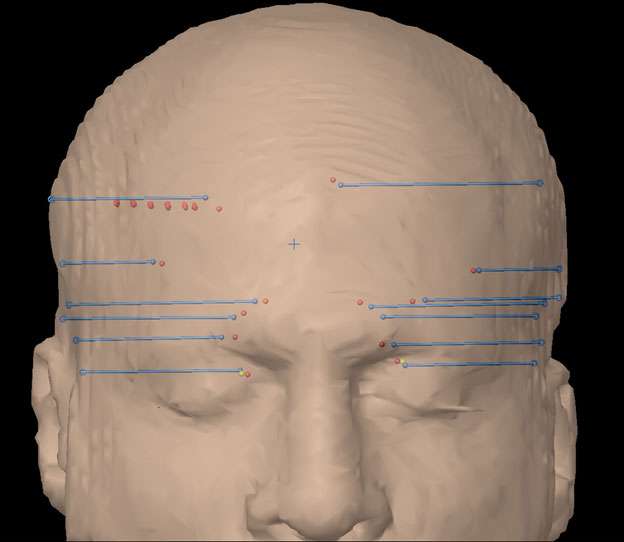 Diagram of a head illustrating depth electrode implant procedure