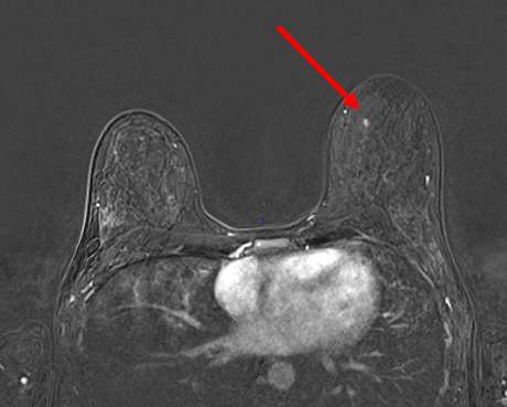 Figure 1. T1 fat-saturated postcontrast axial subtraction MRI demonstrating an enhancing focus in the left breast at 11 o’clock anterior depth.