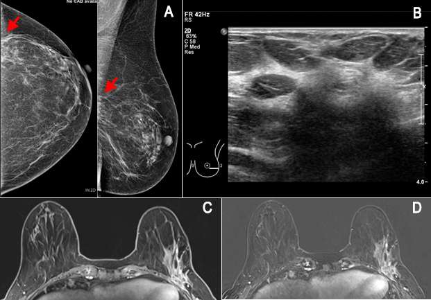 Female with recently diagnosed invasive lobular carcinoma underwent breast MRI for evaluation of extent of disease