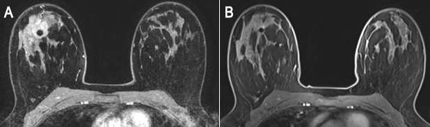 35-year-old female with biopsy proven invasive lobular carcinoma of the right breast underwent imaging for the evaluation of treatment response to neoadjuvant therapy.