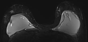 Figure 4. 52-year-old female with left breast tenderness was referred for breast MRI to assess for implant rupture. Axial STIR image shows bilateral silicone breast implants with the linguini sign seen in the left implant, suggestive of intracapsular rupture.