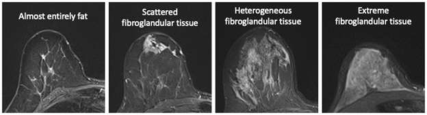 BI-RADS lexicon for the amount of fibroglandular tissue.
