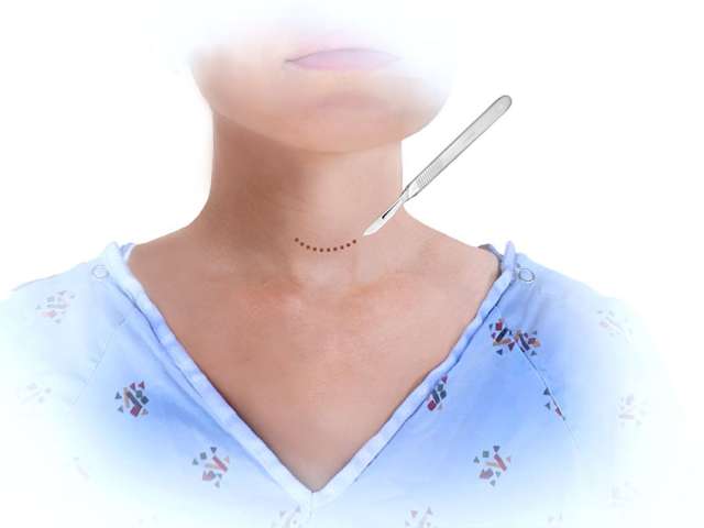 Scar In Neck After Thyroid Surgery