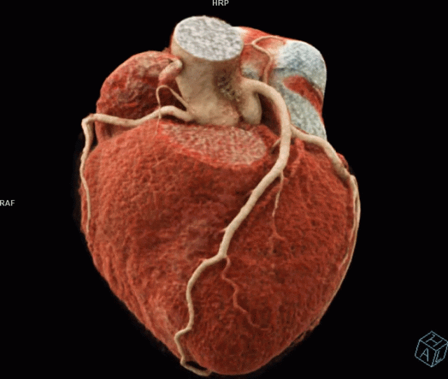 3D Cardiac Rotation