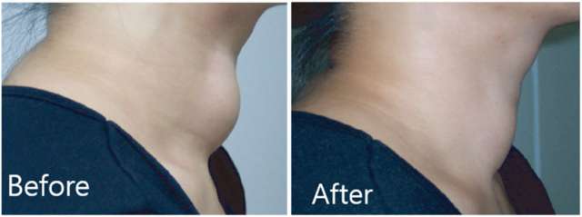Thyroid Radiofrequency Ablation Before and After