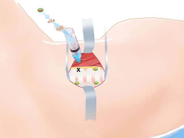 Thyroid Surgery Step 7 Inferior Pole