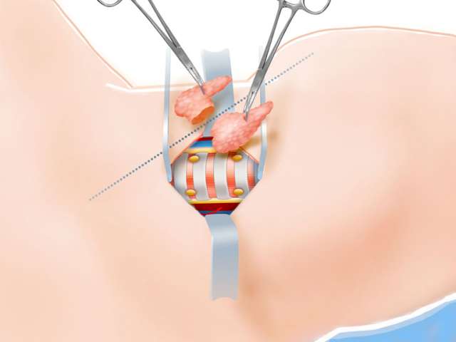 Thyroid Surgery Step 9 Excision and Closure